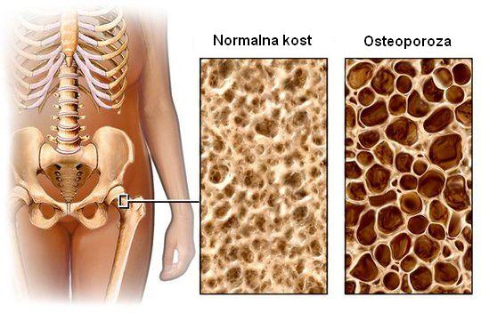 osteoporoza-22