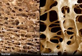 osteoporoza-3