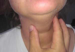 Thyreoiditis lymphocytaria Hashimoto (HT)